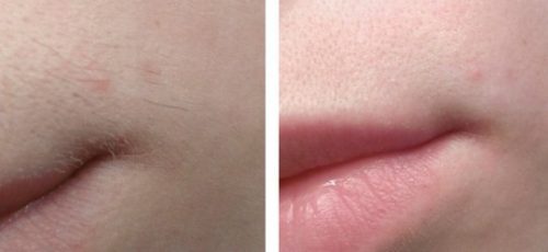 лазерная эпиляция