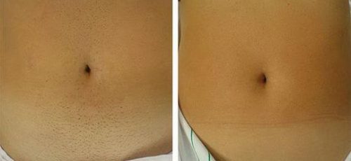 эпиляция в Ташкенте